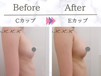 メディカルサロン エム エム エム 銀座プレミアムサロン(M.M.M.)/【バストアップ例】 C→Eカップ