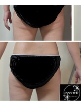 ひぺりかむ/【脂肪冷却】ヒップ下2ブロック
