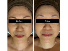 ほうれい線や目の周りのしわも改善されます♪