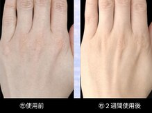 ベリッセ(Belisse)/【Lien】２週間Before/After