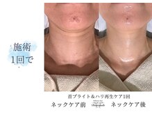 ディアスマイル(Dear.smile)/ネック施術1回で