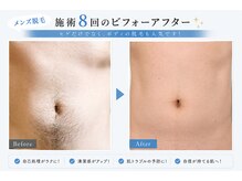 ビビ(bibi)/メンズお腹脱毛施術8回