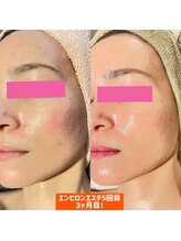 ピュアグレース 自由が丘/30代後半 肌荒れがビタミンAで！