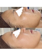 メディカルサロン ティアラ 亀有本店/【IPL光フォト】