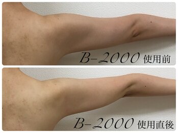 シェミー(CHEZ MEE)/ブライダルエステ（二の腕）