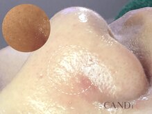 キャンディ 難波心斎橋店(CANDi)/ハイドラピーリング/黒ずみ毛穴