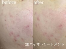 エーアール(ar)/ハーブピーリング/2Bバイオ