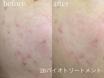 エーアール(ar)/ハーブピーリング/2Bバイオ