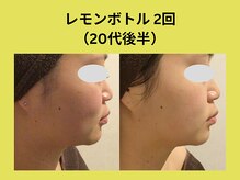 アユアランリンク 錦糸町店/レモンボトル2回