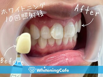 ホワイトニングカフェ 志木店/ホワイトニングビフォーアフター