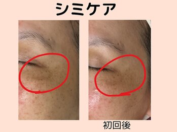 ウィズマツオカ 菊池本店/シミケア