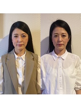 ルディア 堂島店(ledia)/大阪美容鍼 ビフォーアフター