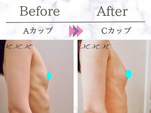 メディカルサロン エム エム エム 銀座プレミアムサロン(M.M.M.)/【バストアップ例】　A→Cカップ