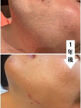 ルタンリッシュオム(Lutan Riche hom)/フェイシャルエステ脱毛！