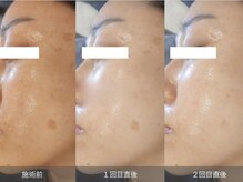 ストーリー 小田原(STORY)/【最新】素肌/再生ダクトピール