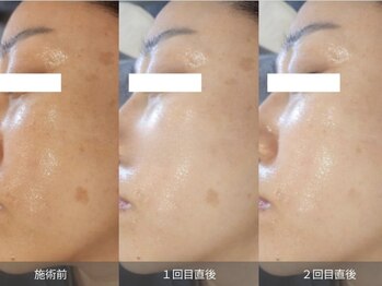 ストーリー 小田原(STORY)/【最新】素肌/再生ダクトピール