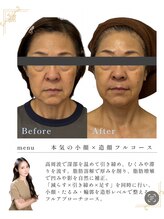 リノン(LIINON)/切らない。入れない。でも叶う