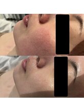 ジル(JilL)/ダクトピールビフォーアフター