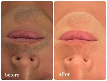 エリクサー 加須店(Elixir)/12回の照射でツルツル目指そう!