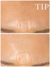 ミエル(miel)/【ハーブピーリング】シワケア