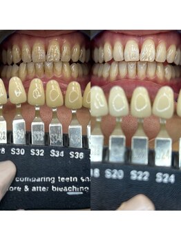 トウキョースワーズ 渋谷店(TOKYO SWRS)/#ホワイトニング #渋谷 #池袋
