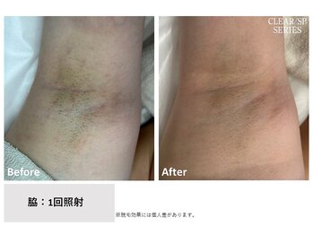 ビープランニング(B-PLANNING.)/【ワキの黒ずみもキレイに★】