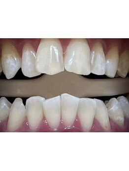 メンズフェイシャル