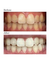 ノーブル 上土店(Noble)/ホワイトニングBeforeAfter