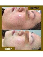 シフォン(Chiffon)/大人ニキビとそのあとケアに