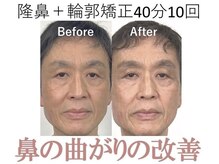 ラプリ 梅田店(Raplit)/隆鼻＋輪郭矯正40分10回