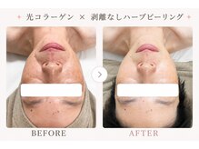パールプラス 伊勢店(Pearl plus)/複数回での施術でお肌悩みが改善