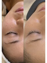 エイティ(Atey)/ハイドロ×脱毛×光フェイシャル