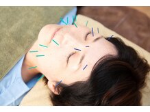 スクナビコナ鍼灸院/美容鍼の様子