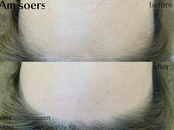 エムソエル/顔脱毛　フェイシャルワックス