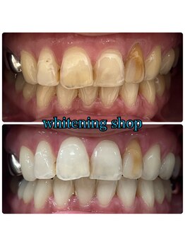 ホワイトニングショップ 大阪玉造店/Before&After美白ホワイトニング