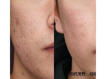 ブレア(Blair)/マイクロニードル×ピンクグロウ