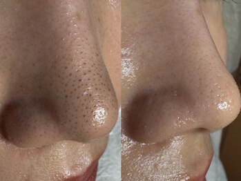 サラグランデ(Sara Grande)/毛穴エクストラクションコース