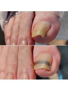 爪切り屋 足楽/爪ケア40分＋ＰＢスパンゲ