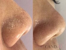 キャンディ 難波心斎橋店(CANDi)/ハイドラピーリング/黒ずみ毛穴