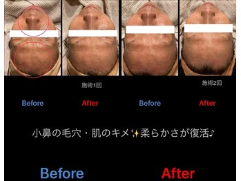 プレミアムキュア/毛穴セラピーの効果
