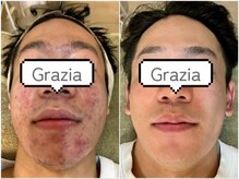 トータルビューティーグラッツィア(Total Beauty Grazia)の雰囲気（男性もこの通り、男女問わずお肌でお悩みの方は是非ご相談を）