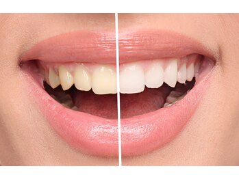 パーチポーチ(PERCH PORCH)の写真/【完全都度払い】【初回セルフホワイトニング1回(8分×2照射)¥2900～】口臭＆歯の色の日常メンテナンスにも