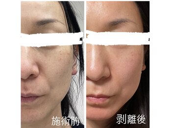 ジーニー(Genie)/リベル　ハーブピーリング