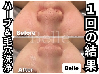ベル 心斎橋店(Belle)/2剤で洗う本格毛穴洗浄