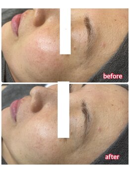 サロンドティアラ(Salon de Tiara)/シミケア(フォト)