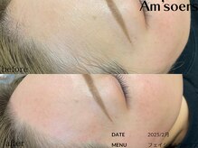 エムソエル/顔脱毛　ワックス＋毛穴洗浄