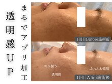 チッチ アフロディーテ(Chicchi Aphrodit)/毛穴洗浄×ハーブピーリング