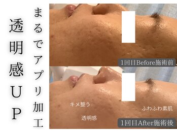 チッチ アフロディーテ(Chicchi Aphrodit)/毛穴洗浄×ハーブピーリング