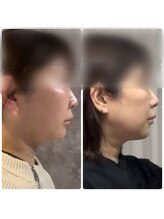 ドゥーソル 谷町四丁目店(due sole)/谷四/レモンボトル2cc