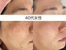 シミケア専門店 SAKURA 平塚店/平塚シミケア/伊勢店シミケア